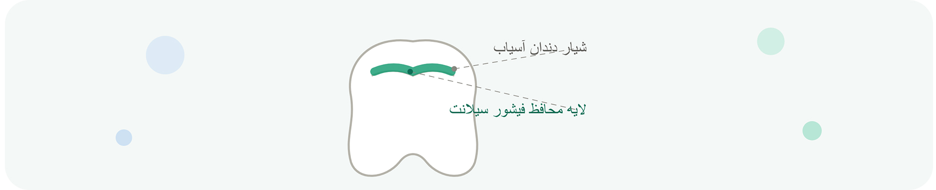 فیشور سیلانت چیست